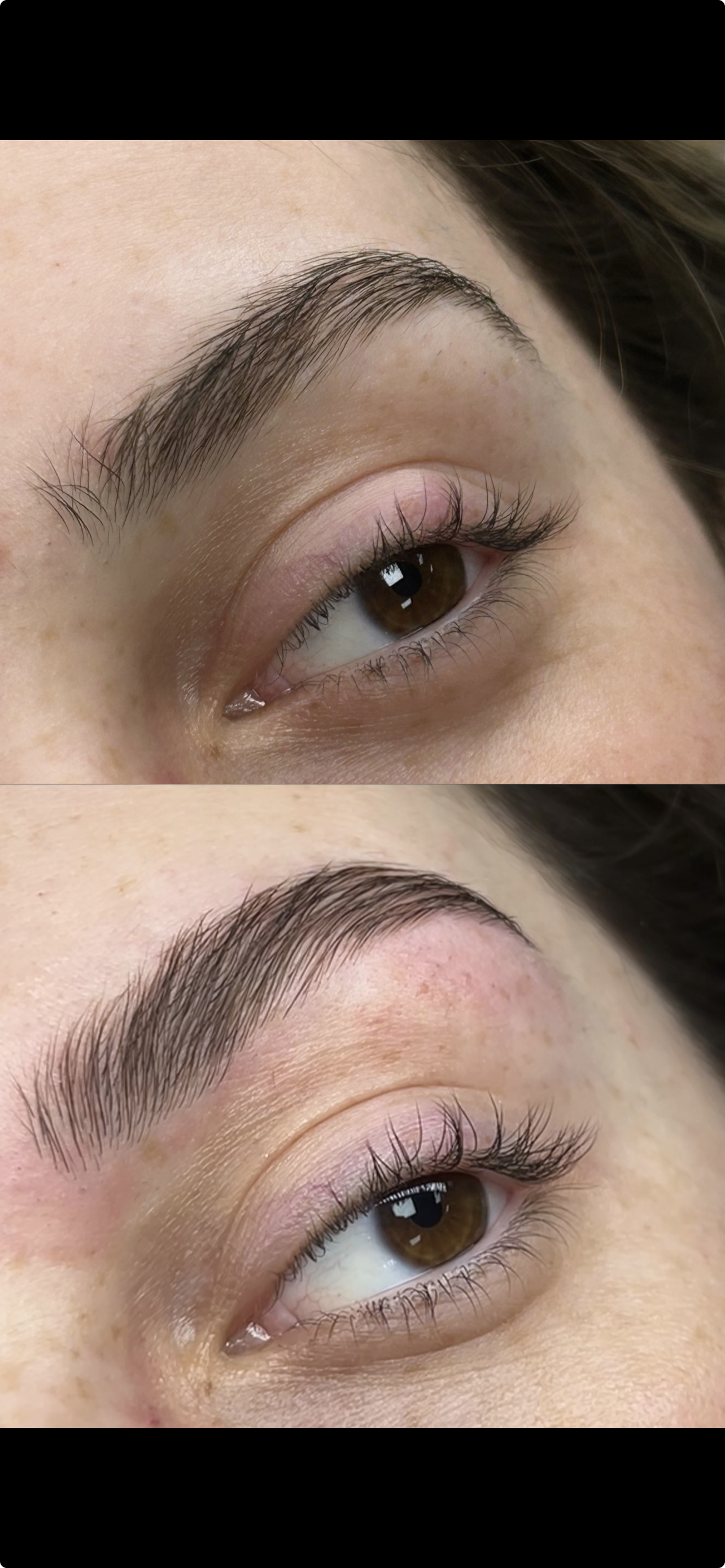 Alicia – Browlift